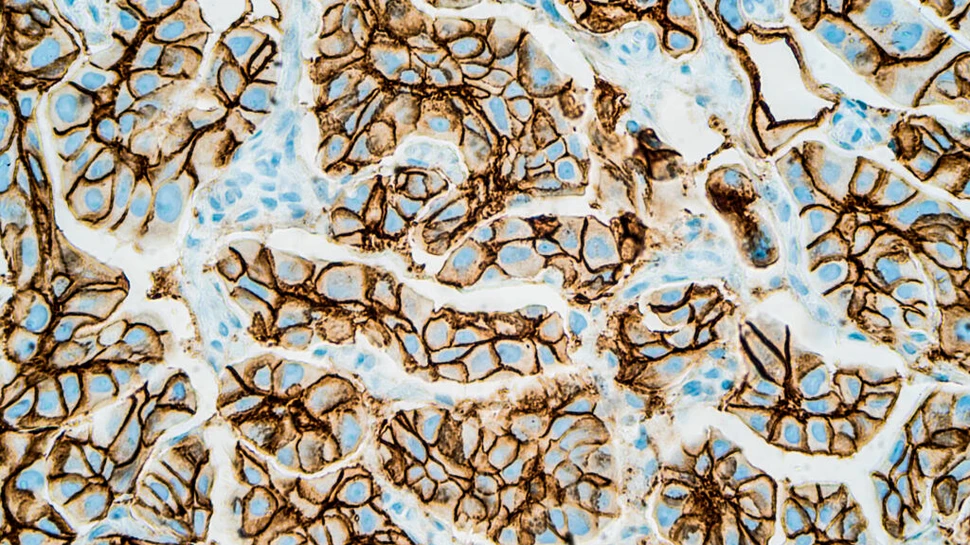 Terapia cu lumină ar putea ținti și ucide eficient celulele canceroase