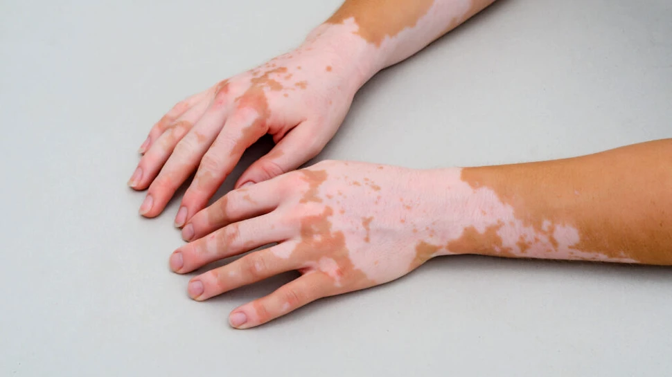 Un medicament pentru persoanele cu vitiligo a avut rezultate promițătoare într-un studiu clinic