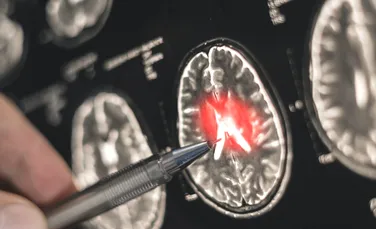 Scleroza laterală amiotrofică, boala care oprește corpul dar lasă mintea prizonieră