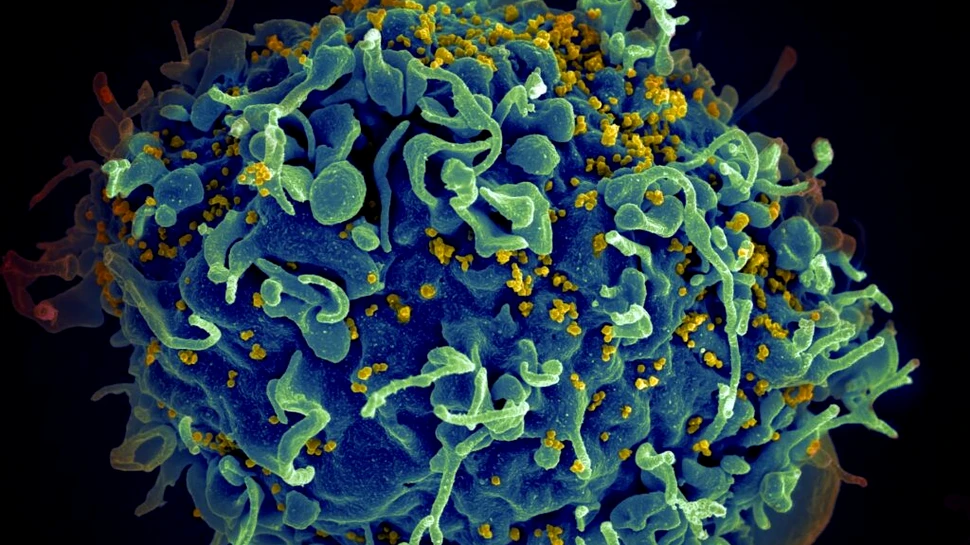 HIV poate accelera îmbătrânirea persoanelor infectate, sugerează un studiu