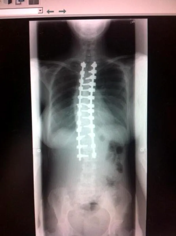 Radiografia coloanei, după intervenţie