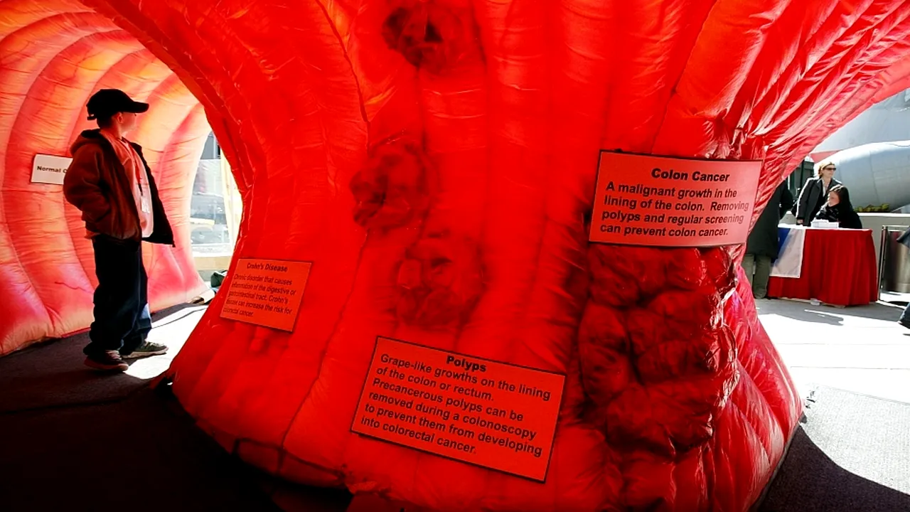 1-cancer-colorectal 