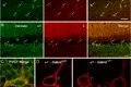 Un medicament a restabilit amintirile pierdute din cauza bolii Alzheimer