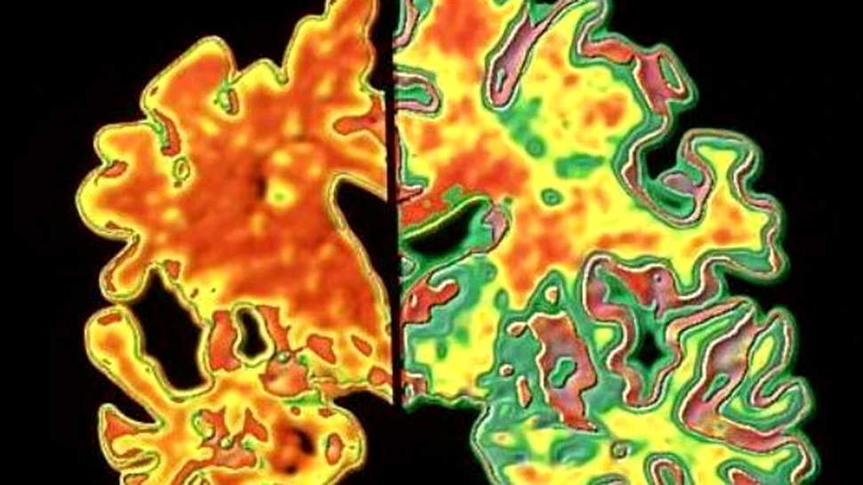 Religiozitatea incetineste progresul dementei senile