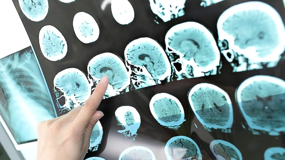 Un nou studiu identifică două proteine care pot contribui la recidiva accidentului vascular cerebral