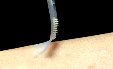 Oamenii de ştiinţă au creat un plasture nedureros care poate controla diabetul fără injecţii – FOTO+VIDEO