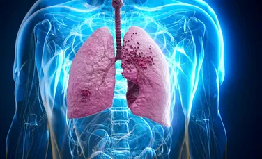 A fost aprobat primul tratament pentru o boală pulmonară gravă