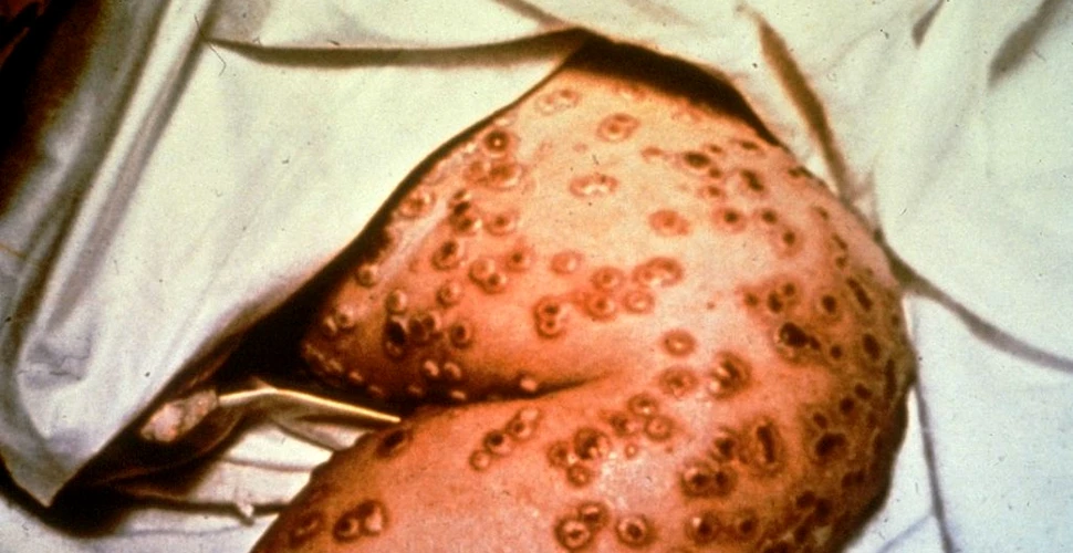 Primul caz cunoscut de infecție simultană cu variola maimuței, COVID-19 și HIV