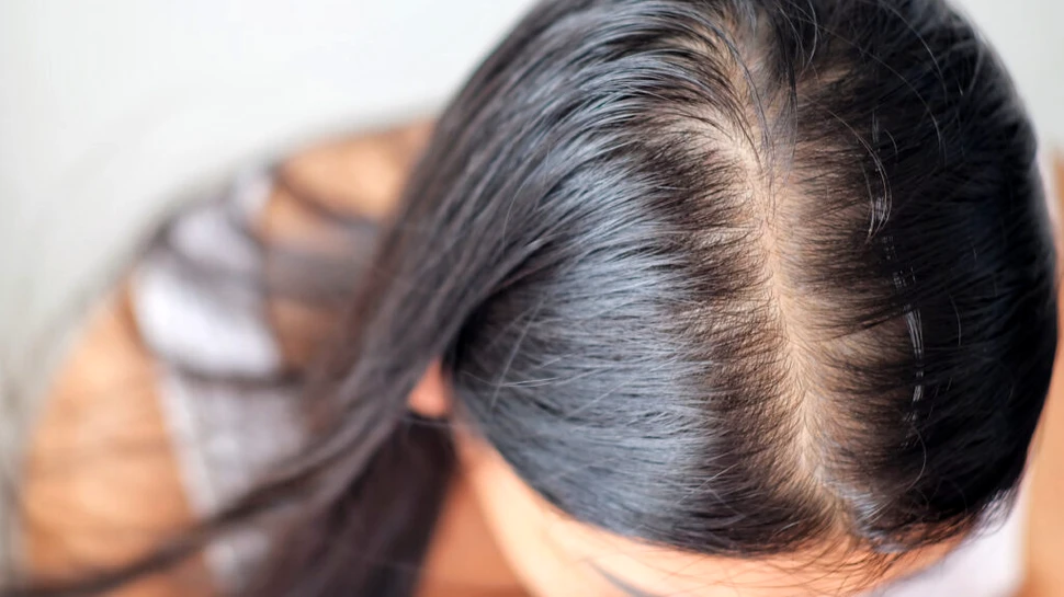 Un medicament care ar putea trata pierderea părului, tot mai aproape de realitate