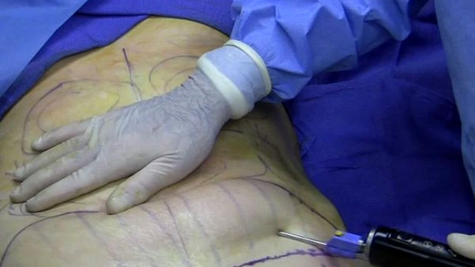 Grasimea extrasa prin liposuctie – sursa de celule stem