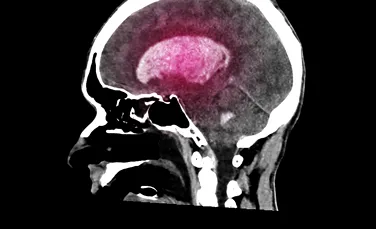 Inteligența Artificială poate trata tumorile cerebrale mai rapid și mai eficient