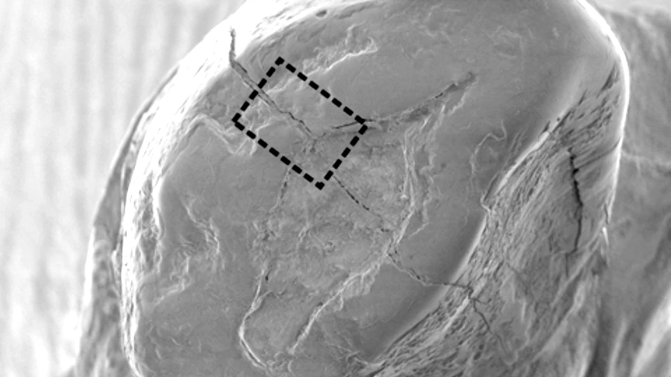 Stomatologie în Epoca de Piatră: a fost descoperită cea mai veche plombă dentară