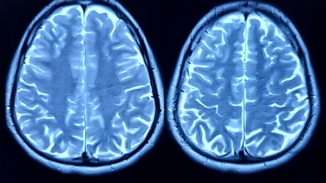 Depresia ar putea afecta capacitatea creierului de a genera noi neuroni