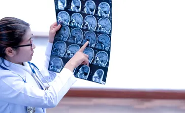 O metodă ingenioasă deschide o cale nouă de a detecta leziunile cerebrale după AVC
