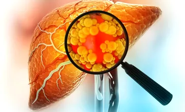 O formă severă de boală hepatică ar putea fi inversată de scăderea rapidă în greutate