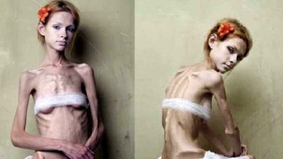 Anorexia? Sora mai mica a Schizofreniei…