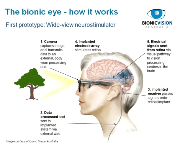  cum functioneaza un ochi bionic