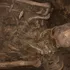 „Vezică biliară de porțelan”, găsită într-un mormânt vechi de 100 de ani