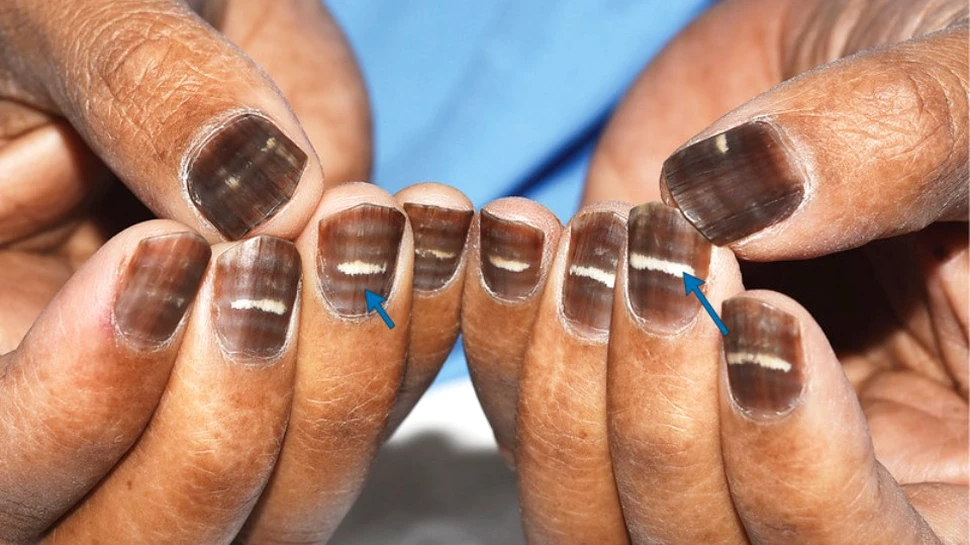 Unghiile unui bărbat s-au înnegrit şi pe ele au apărut dungi albe orizontale. Efectul extrem de rar al celui mai frecvent tratament utilizat pentru o boală cruntă