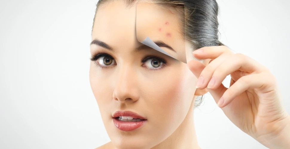 Deşi pare surprinzător, problemele cu acneea aduc şi avantaje. Pielea va îmbătrâni mai greu