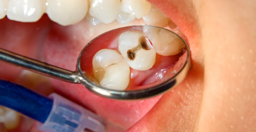 Mai bine de jumătate dintre copii și adulții din România au carii dentare