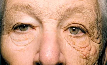 FOTO. Efectele extrem de nocive pe care le poate avea soarele asupra pielii. Imaginea acestui bărbat te poate îngrozi