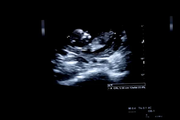 Ecografia unui fetus uman de trei luni de zile.