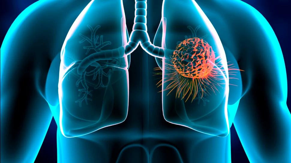 Oamenii de știință au descoperit cum declanșează poluarea cancerul pulmonar