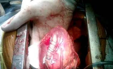Chirurgii au creat un muschi coronarian din maduva