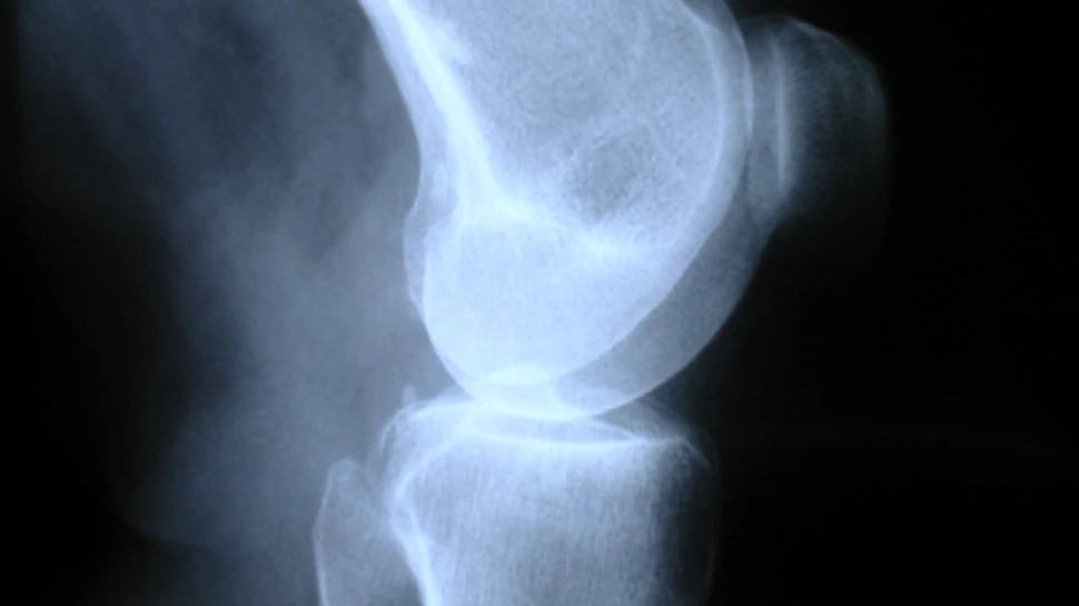 Un nou biomaterial stimuleaza regenerarea osoasa