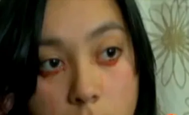 Cazul care îi surprinde pe medici: o tânără plânge cu lacrimi de sânge (VIDEO)