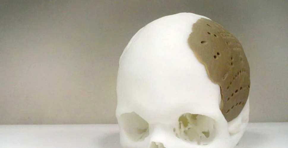Operaţie în premieră: craniul unui om a fost “reparat” cu ajutorul unui implant realizat prin printare 3-D