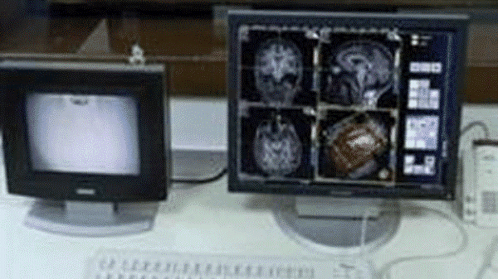 Noi sperante pentru suferinzii de epilepsie