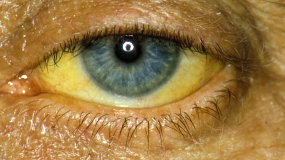 Bolile hepatice produse de alcool fac victime în randul tinerilor