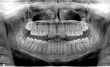 Care sunt tipurile de radiografii dentare utilizate în stomatologie