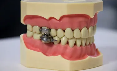 O nouă metodă de a slăbi. Dispozitivul împiedică deschiderea gurii mai mult de 2 mm