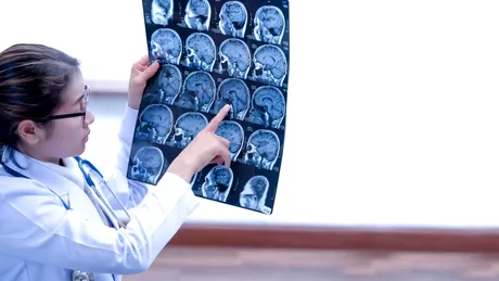 O metodă ingenioasă deschide o cale nouă de a detecta leziunile cerebrale după AVC