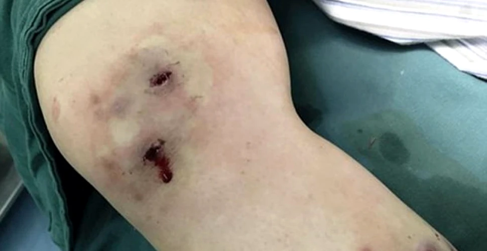 O femeie a trecut prin clipe îngrozitoare când un vierme a ieşit din genunchiul acesteia după o călătorie în Brazilia – FOTO