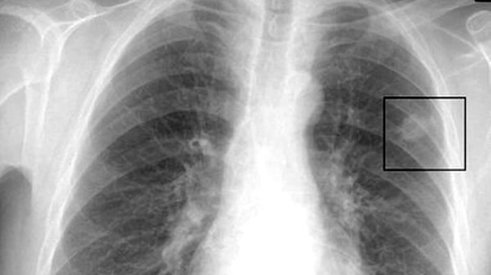 In anii 2030, cancerul va ucide peste 13 milioane de oameni anual