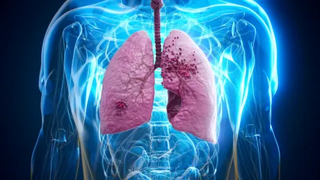 Mecanismul prin care celulele ombilicale pot opri cancerul