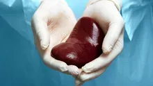 A murit bărbatul cu primul transplant de rinichi de porc modificat genetic din lume