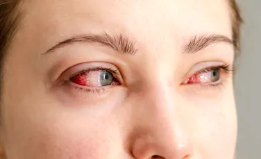 „Ochiul roșu”: Când o simplă iritație ascunde o infecție și de ce automedicația este riscantă (P)