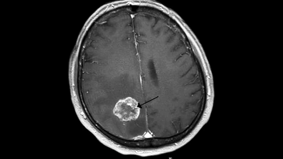 „Doctorii” banale ar putea opri dezvoltarea unor tumori canceroase