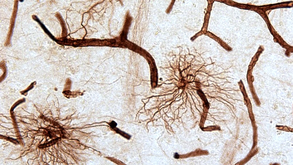 Cercetări post-mortem dezvăluie diferențe clare ale celulelor creierului la oamenii care suferă de depresie