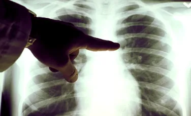 Principala cauză de mortalitate în rândul bărbaţilor este cancerul pulmonar