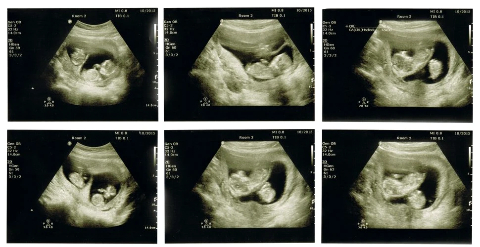 O femeie a născut gemeni, după ce a rămas însărcinată în timp ce era deja gravidă