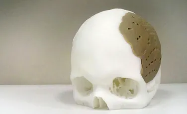 Operaţie în premieră: craniul unui om a fost “reparat” cu ajutorul unui implant realizat prin printare 3-D