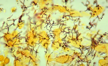 Cea mai veche dovadă pentru originea sifilisului, descoperită pe un schelet vechi de 5.500 de ani