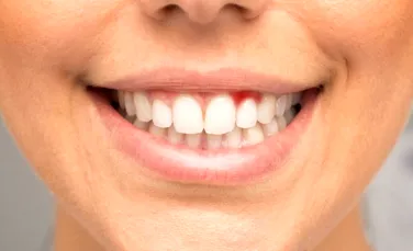 Sângerarea gingiilor ar putea fi un semn precoce al unei afecțiuni mult mai grave