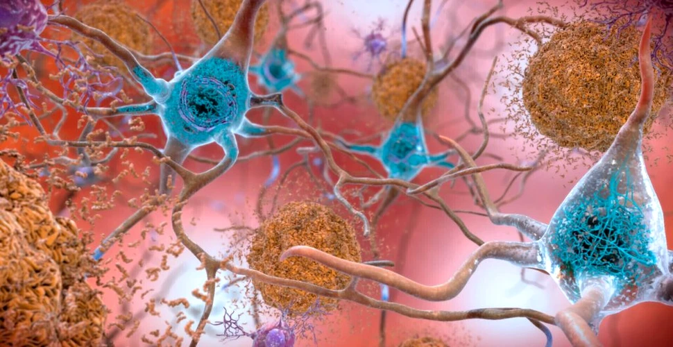 Un nou medicament pentru Alzheimer ar putea încetini declinul cognitiv cu 35%